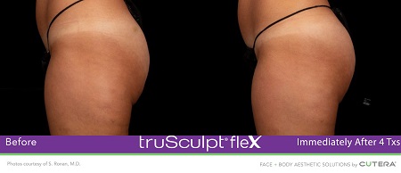 B & A Trusculpt Flex B & A Trusculpt Flex