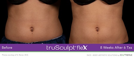 B & A Trusculpt Flex B & A Trusculpt Flex