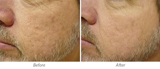 Acne Scars Treatment before and after