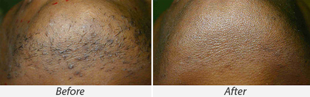 Before and After Coolglide Laser Hair Removal Treatment