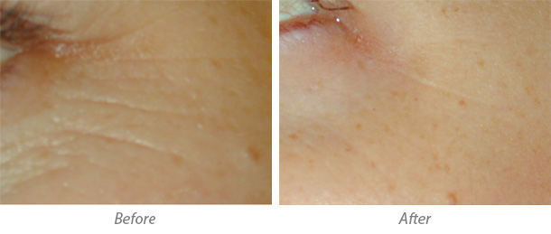 Laser Genesis Treatment before and after
