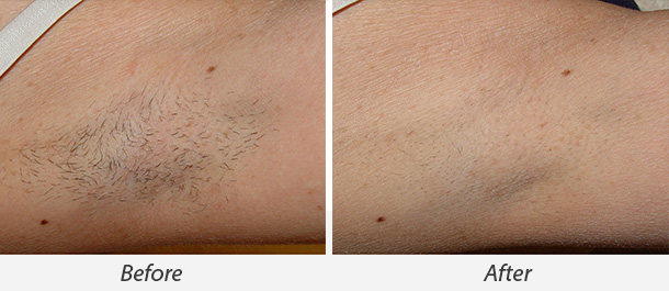 Before and After Prowave Laser Hair Removal Treatment