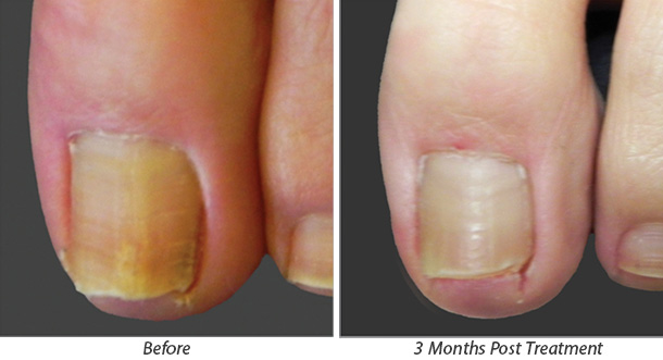 Before and After Toenail Fungus Treatment