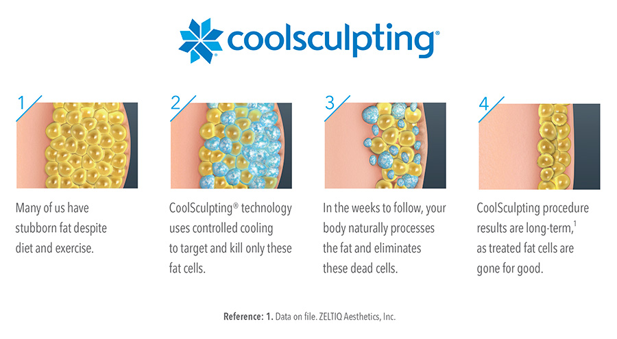 CoolSculpting technology