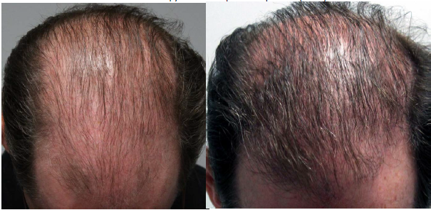 B & A Eclipse MicroPen Hair Restoration