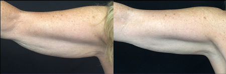 Before and After Trusculpt iD-hands