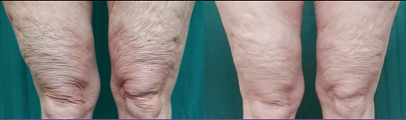 Before and After Trusculpt iD