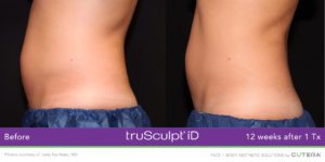 truSculpt-iD-B&A-side view of female abdomen
